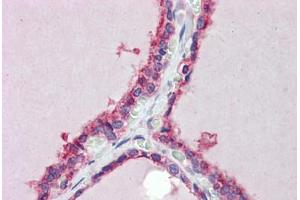 Human Thyroid (formalin-fixed, paraffin-embedded) stained with TRIM8 antibody ABIN462222 followed by biotinylated goat anti-rabbit IgG secondary antibody ABIN481713, alkaline phosphatase-streptavidin and chromogen.