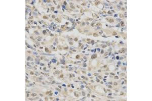 Immunohistochemistry of paraffin-embedded human gastric cancer using SPHK1 Antibody (ABIN5970017) at dilution of 1/200 (40x lens). (SPHK1 anticorps)