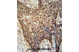 METTL4 antibody (C-term) immunohistochemistry analysis in formalin fixed and paraffin embedded human Lung carcinoma followed by peroxidase conjugation of the secondary antibody and DAB staining.