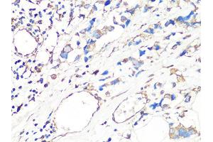 Immunohistochemistry of paraffin-embedded human breast cancer using MMP2 Antibody (ABIN4904395) at dilution of 1:100 (40x lens). (MMP2 anticorps)