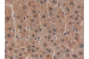 Detection of HPRT1 in Human Liver cancer Tissue using Polyclonal Antibody to Hypoxanthine Phosphoribosyltransferase 1 (HPRT1)