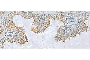 Immunohistochemistry of paraffin-embedded Human prost ate cancer tissue using PLA2G15 Polyclonal Antibody at dilution of 1:65(x200) (PLA2G15 anticorps)