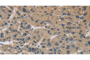 Immunohistochemistry of paraffin-embedded Human liver cancer using CYR61 Polyclonal Antibody at dilution of 1:60 (CYR61 anticorps)