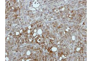 IHC-P Image Immunohistochemical analysis of paraffin-embedded NCIN87 xenograft, using Pyruvate Kinase (liver/RBC), antibody at 1:500 dilution.