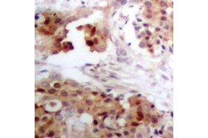Immunohistochemical analysis of APOBEC3G staining in human breast cancer formalin fixed paraffin embedded tissue section.