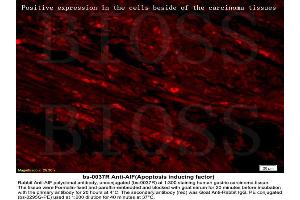 Formalin-fixed and paraffin embedded labeled with human gastric carcinoma Rabbit Anti-AIF Polyclonal Antibody, Unconjugated (ABIN724010) 1:300 followed by conjugation to the secondary antibody Goat Anti-Rabbit IgG, PE