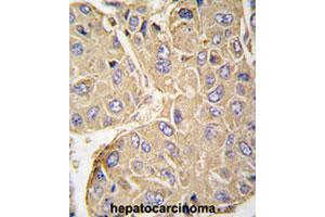 Formalin-fixed and paraffin-embedded human hepatocarcinomareacted with PTPN7 polyclonal antibody , which was peroxidase-conjugated to the secondary antibody, followed by AEC staining. (PTPN7 anticorps  (Ser44))
