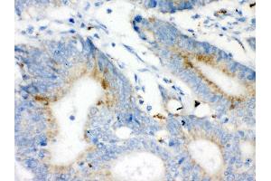 Anti-VDAC Picoband antibody, IHC(P) IHC(P): Human Intestinal Cancer Tissue