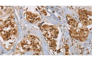 Immunohistochemistry of paraffin-embedded Human breast cancer tissue using RAB24 Polyclonal Antibody at dilution 1:45 (RAB24 anticorps)