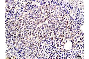 Formalin-fixed and paraffin-embedded mouse tumor labeled with Rabbit Anti-IDE Polyclonal Antibody, Unconjugated (ABIN723680) at 1:300 followed by conjugation to the secondary antibody and DAB staining
