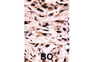 Formalin-fixed and paraffin-embedded human breast cancer tissue reacted with SMAD4 (phospho T277) polyclonal antibody  which was peroxidase-conjugated to the secondary antibody followed by DAB staining. (SMAD4 anticorps  (Thr277))
