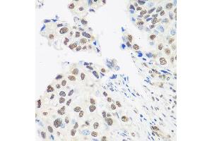 Immunohistochemistry of paraffin-embedded human prostate cancer using DDX39B antibody at dilution of 1:100 (40x lens). (DDX39B anticorps)
