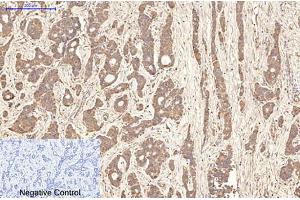 Immunohistochemical analysis of paraffin-embedded human liver cancer tissue. (Aquaporin 4 anticorps)