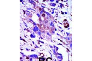 Formalin-fixed and paraffin-embedded human cancer tissue reacted with the primary antibody, which was peroxidase-conjugated to the secondary antibody, followed by AEC staining. (PLK1 anticorps  (C-Term))