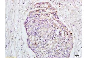 Formalin-fixed and paraffin embedded human rectal carcinoma tissue labeled with Rabbit Anti-GPR30 Polyclonal Antibody  at 1:200 followed by conjugation to the secondary antibody and DAB staining.