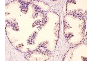 IHC testing of FFPE human prostate cancer tissue with GAA antibody at 1ug/ml. (GAA anticorps  (AA 494-527))
