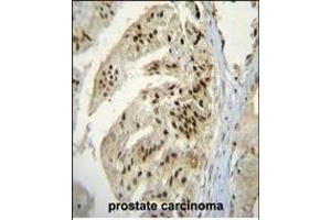 P Antibody (Center) (ABIN655637 and ABIN2845116) immunohistochemistry analysis in formalin fixed and raffin embedded human prostate carcinoma followed by peroxidase conjugation of the secondary antibody and DAB staining. (ACPP anticorps  (AA 407-435))