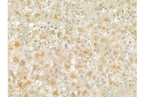 ABIN6258516 and ABIN6274735 at 1/100 staining human astrocytoma by IHC-P.