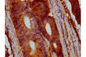 IHC image of ABIN7175553 diluted at 1:400 and staining in paraffin-embedded human colon cancer performed on a Leica BondTM system.