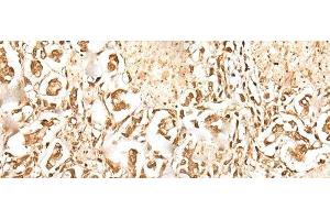 Immunohistochemistry of paraffin-embedded Human gastric cancer tissue using ZUFSP Polyclonal Antibody at dilution of 1:35(x200) (ZUFSP anticorps)