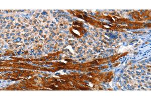 Immunohistochemistry of paraffin-embedded Human liver cancer using AOX1 Polyclonal Antibody at dilution of 1:65 (AOX1 anticorps)