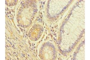 Immunohistochemistry of paraffin-embedded human colon cancer using ABIN7174650 at dilution of 1:100 (ALG14 anticorps  (AA 25-216))