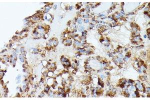 Immunohistochemistry of paraffin-embedded Human thyroid cancer using NUBP1 Polyclonal Antibody at dilution of 1:100 (40x lens). (NUBP1 anticorps)