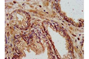 IHC image of ABIN7157591 diluted at 1:400 and staining in paraffin-embedded human prostate cancer performed on a Leica BondTM system. (KIF13B anticorps  (AA 1531-1701))