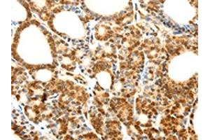 The image on the left is immunohistochemistry of paraffin-embedded Human thyroid cancer tissue using ABIN7128859(CDH23 Antibody) at dilution 1/80, on the right is treated with fusion protein. (CDH23 anticorps)