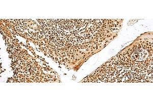 Immunohistochemistry of paraffin-embedded Human tonsil tissue using GRSF1 Polyclonal Antibody at dilution of 1:30(x200) (GRSF1 anticorps)