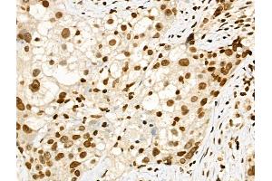 Phospho-SMC1 (Ser957) Antibody at 1/100 staining Human ovarian cancer by IHC-P. (SMC1A anticorps  (pSer957))