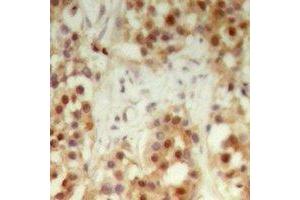 Immunohistochemical analysis of NXF3 staining in human breast cancer formalin fixed paraffin embedded tissue section. (NXF3 anticorps)