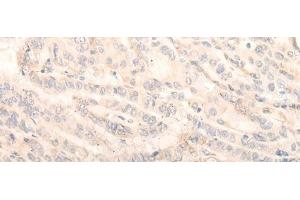 Immunohistochemistry of paraffin-embedded Human thyroid cancer tissue using INPP1 Polyclonal Antibody at dilution of 1:35(x200) (INPP1 anticorps)