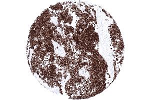 Soft tissue Strong desmin positivity of all tumor cells of a rhabdomyosarcoma