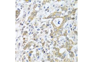 Immunohistochemistry of paraffin-embedded human gastric cancer using TICAM1 antibody (ABIN6292306) at dilution of 1:100 (40x lens). (TICAM1 anticorps)