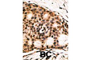 Formalin-fixed and paraffin-embedded human cancer tissue reacted with CDX1 polyclonal antibody  , which was peroxidase-conjugated to the secondary antibody, followed by AEC staining. (CDX1 anticorps  (C-Term))