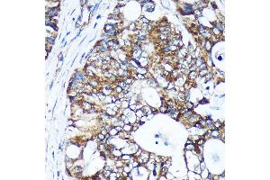 Immunohistochemistry of paraffin-embedded Human colon carcinoma using GULP1 Rabbit pAb (ABIN6131564, ABIN6141541, ABIN6141542 and ABIN6220256) at dilution of 1:100 (40x lens). (GULP1 anticorps  (AA 1-130))