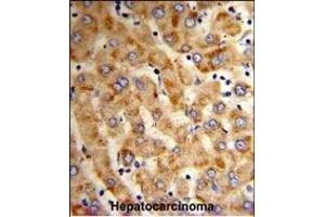 Formalin-fixed and paraffin-embedded human hepatocarcinoma reacted with HYOU1 Antibody (Center), which was peroxidase-conjugated to the secondary antibody, followed by DAB staining. (HYOU1 anticorps  (AA 274-303))