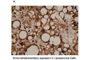 Immunohistochemical staining of human liposarcoma cells using CYP4F11 antibody . (CYP4F11 anticorps  (C-Term))