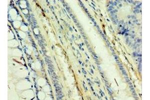 Immunohistochemistry of paraffin-embedded human colon cancer using ABIN7171470 at dilution of 1:100 (TAF5L anticorps  (AA 1-325))