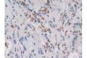 Detection of MIB2 in Human Lung cancer Tissue using Polyclonal Antibody to Mindbomb Homolog 2 (MIB2)