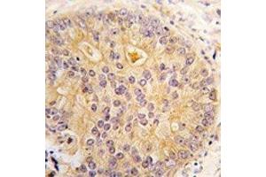 IHC analysis of FFPE human prostate carcinoma tissue stained with CAMKK2 antibody (CAMKK2 anticorps  (AA 52-82))