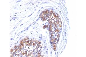 Formalin-fixed, paraffin-embedded human Breast Carcinoma stained with MUC-1 / EMA Mouse Monoclonal Antibody (MUC1/520). (MUC1 anticorps)