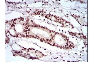 Immunohistochemical analysis of paraffin-embedded colon cancer tissues using KHDRBS2 mouse mAb with DAB staining. (KHDRBS2 anticorps  (AA 160-349))