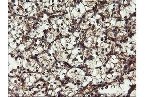 Immunohistochemical staining of paraffin-embedded Carcinoma of Human kidney tissue using anti-DOK7 mouse monoclonal antibody. (DOK7 anticorps)