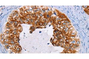 Immunohistochemistry of paraffin-embedded Human cervical cancer using CK-13 Polyclonal Antibody at dilution of 1:35 (Cytokeratin 13 anticorps)