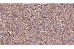 ABIN6273188 at 1/100 staining Human lymph cancer tissue by IHC-P.