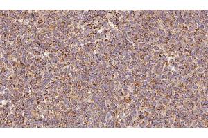 ABIN6273188 at 1/100 staining Human lymph cancer tissue by IHC-P. (Slc30a3 anticorps  (C-Term))