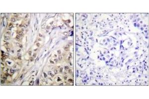 Immunohistochemistry analysis of paraffin-embedded human breast carcinoma tissue, using Survivin (Ab-117) Antibody. (Survivin anticorps  (AA 86-135))