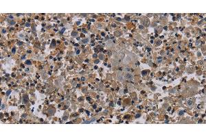 Immunohistochemistry of paraffin-embedded Human lung cancer using NECTIN4 Polyclonal Antibody at dilution of 1:60